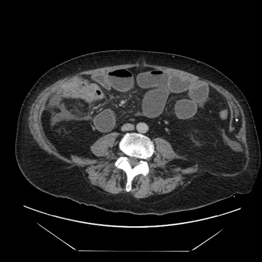 Cecal adenocarcinoma (Radiopaedia 64871-73817 A 58).jpg