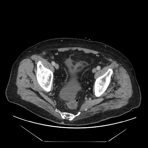 Cecal adenocarcinoma (Radiopaedia 64871-73817 A 84).jpg