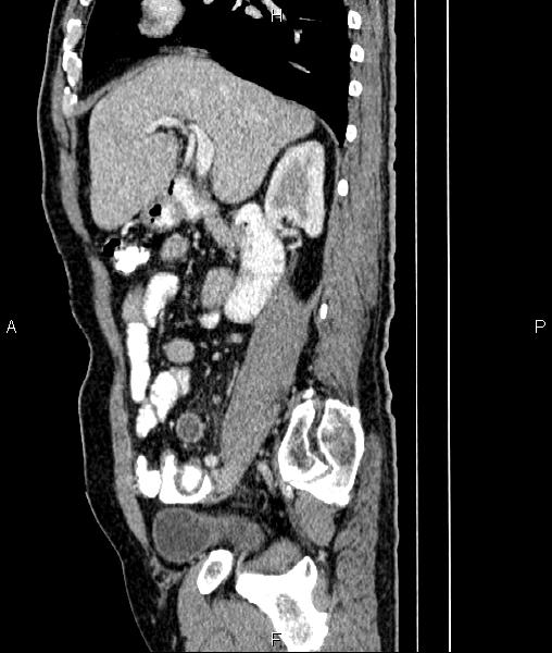 File:Cecal cancer with appendiceal mucocele (Radiopaedia 91080-108651 E 35).jpg