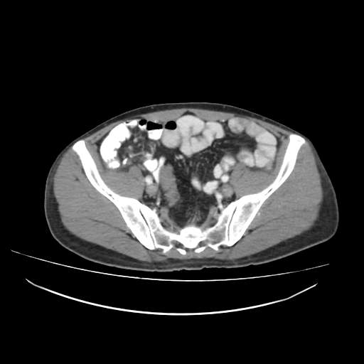 Cecal carcinoma with local lymphadenopathy (Radiopaedia 31428-32240 A 41).jpg