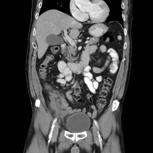 File:Cecal mass causing appendicitis (Radiopaedia 59207-66531 B 22).jpg