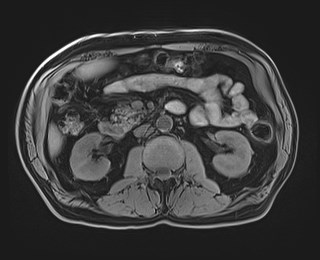 Cecal mass causing appendicitis (Radiopaedia 59207-66532 Axial T1 62).jpg