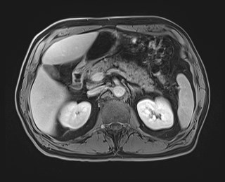 Cecal mass causing appendicitis (Radiopaedia 59207-66532 J 49).jpg