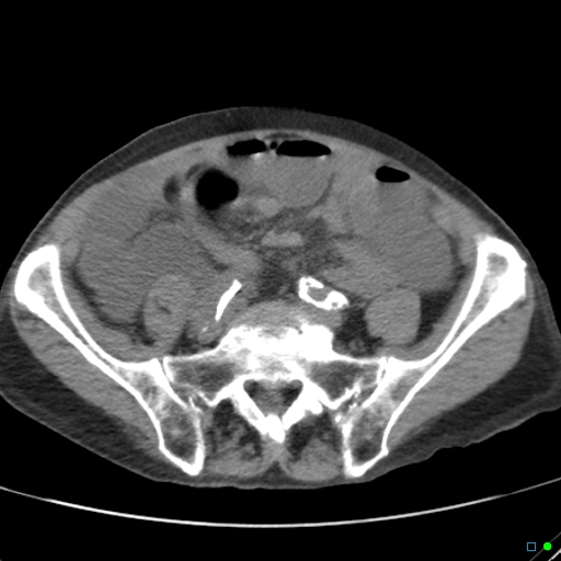 Cecal volvulus - atypical (Radiopaedia 21637-21588 non-contrast 50).jpg