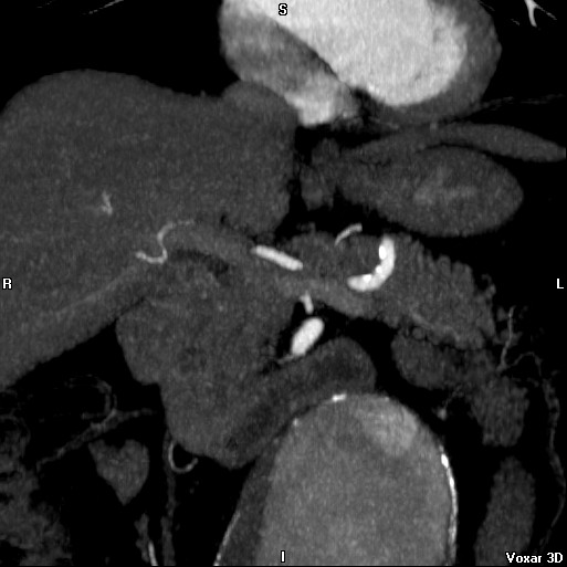 File:Celiac artery anatomy (Radiopaedia 16763-16476 A 7).jpg
