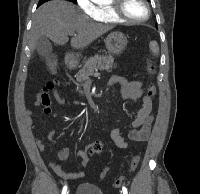 Celiac artery dissection (Radiopaedia 52194-58080 C 15).jpg