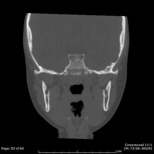 Central giant cell granuloma (Radiopaedia 45612-49754 Coronal bone window 53).jpg