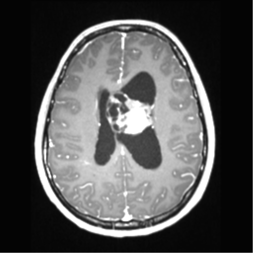 Central neurocytoma (Radiopaedia 37664-39557 Axial T1 C+ 51).png