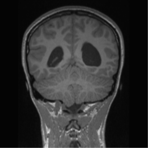 Central neurocytoma (Radiopaedia 37664-39557 Coronal T1 29).png