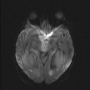 Central neurocytoma (Radiopaedia 56690-63469 Axial DWI 26).jpg