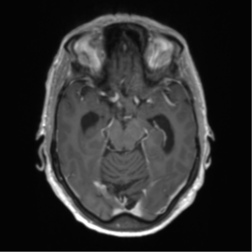 Central neurocytoma (Radiopaedia 65317-74345 Axial T1 C+ 18).png