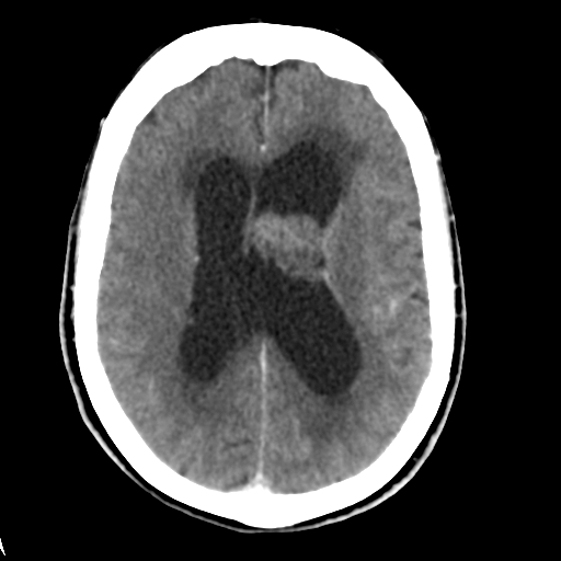 Central neurocytoma (Radiopaedia 65317-74346 Axial C+ delayed 30).png