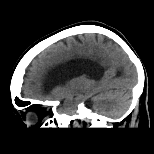 File:Central neurocytoma (Radiopaedia 65317-74346 C 21).png