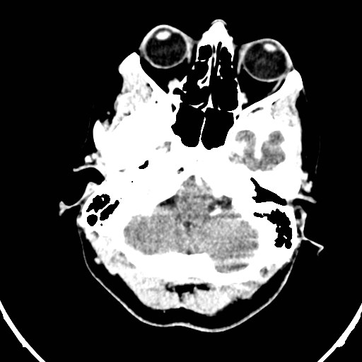 Central neurocytoma (Radiopaedia 84497-99871 B 3).jpg