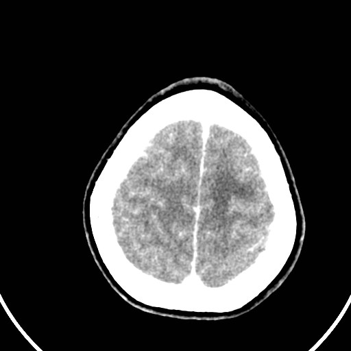 Central neurocytoma (Radiopaedia 84497-99871 B 43).jpg