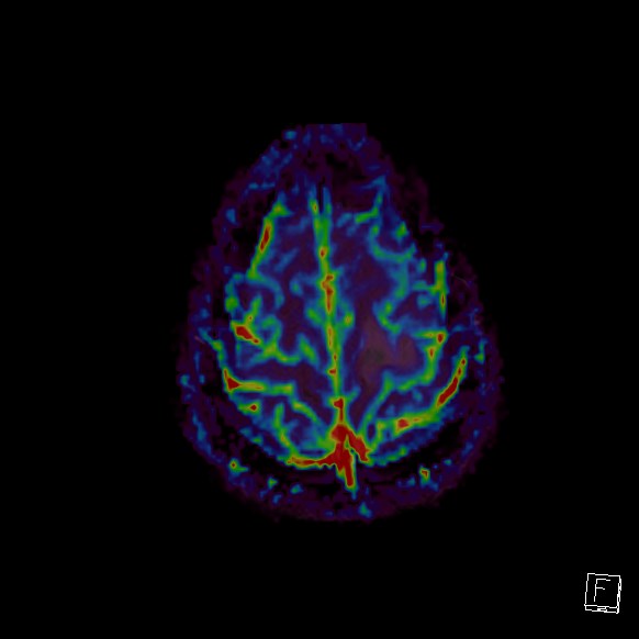 Central neurocytoma (Radiopaedia 84497-99872 Axial Perfusion 37).jpg