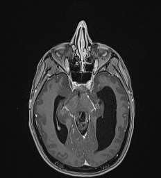 File:Central neurocytoma (Radiopaedia 84497-99872 Axial T1 C+ 61).jpg