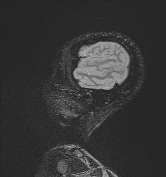 File:Central neurocytoma (Radiopaedia 84497-99872 Sagittal Flair + Gd 134).jpg