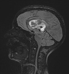 File:Central neurocytoma (Radiopaedia 84497-99872 Sagittal Flair + Gd 75).jpg