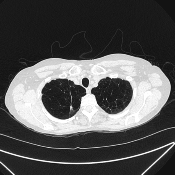 Centrilobular pulmonary emphysema (Radiopaedia 24495-24789 Axial lung window 11).jpg