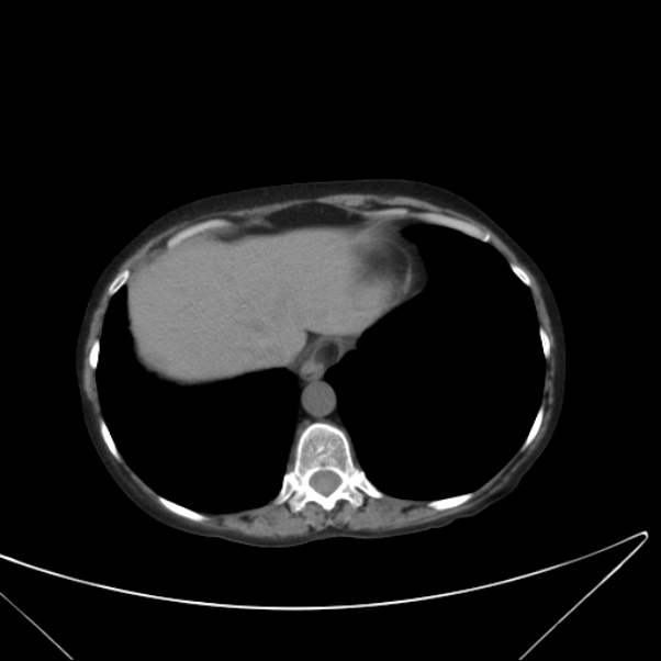 Centrilobular pulmonary emphysema (Radiopaedia 24495-24789 Axial non-contrast 40).jpg