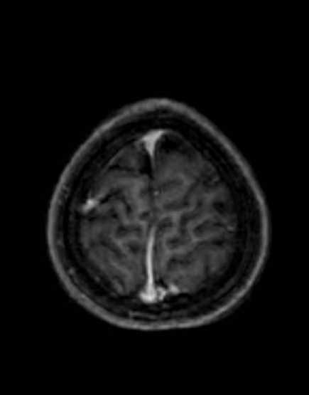 Cerebellar abscess (Radiopaedia 73727-84563 Axial T1 C+ fat sat 97).jpg