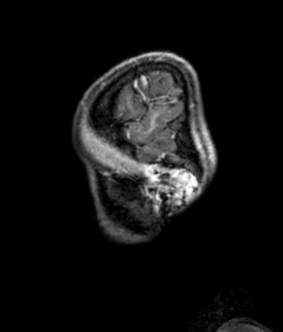 Cerebellar abscess (Radiopaedia 73727-84563 J 63).jpg