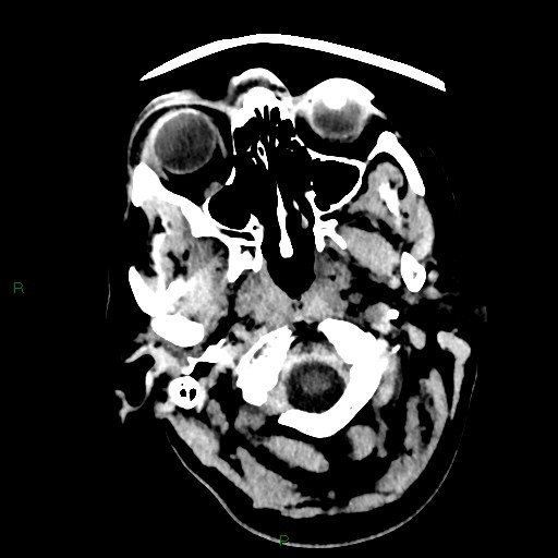 Cerebellar abscess (Radiopaedia 78135-90671 Axial non-contrast 5).jpg