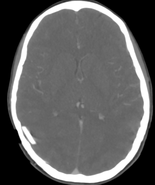 Cerebellar arteriovenous malformation- with hemorrhage (Radiopaedia 35752-37297 B 28).png