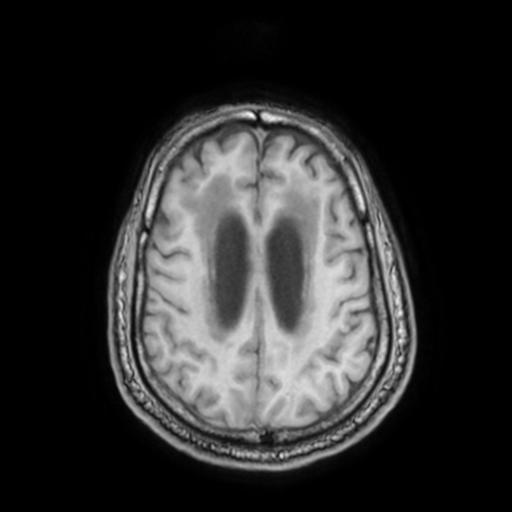File:Cerebellar hemangioblastoma (Radiopaedia 88055-104622 Axial T1 26).jpg