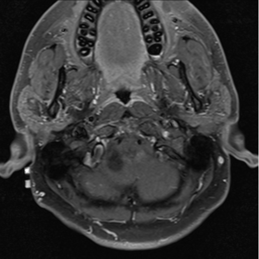 File:Cerebellar hemangioblastomas and pituitary adenoma (Radiopaedia 85490-101176 Axial T1 C+ fat sat 4).png