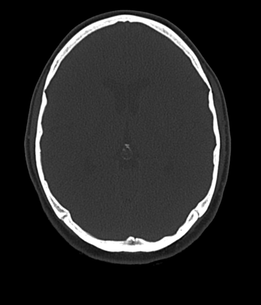 Cerebellar metastases - colorectal adenocarcinoma (Radiopaedia 40947-43652 AX Bone C- 2.0 MPR 31).png
