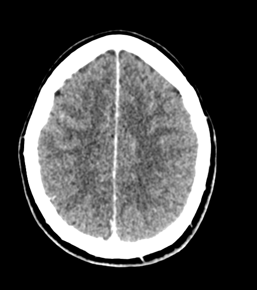 File:Cerebellar metastases - colorectal adenocarcinoma (Radiopaedia 40947-43652 Axial C+ 48).png