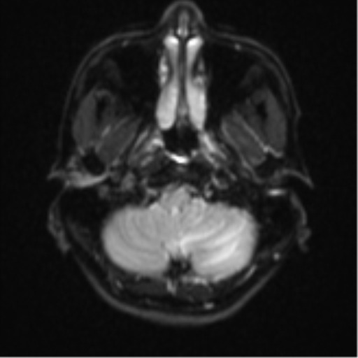Cerebellar metastasis - adenocarcinoma lung (Radiopaedia 63184-71715 Axial DWI 4).png