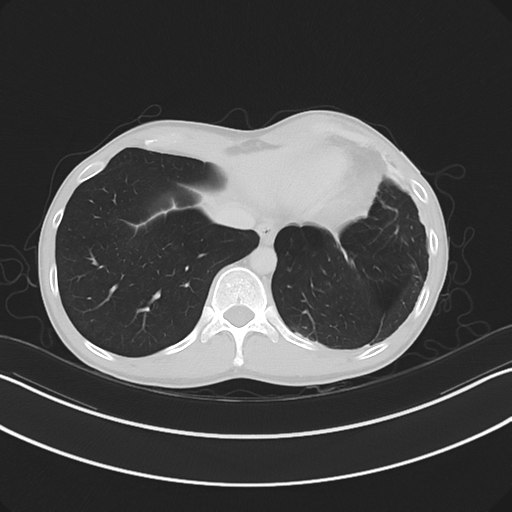 Cerebellar metastasis - adenocarcinoma lung (Radiopaedia 63184-71717 Axial lung window 56).png