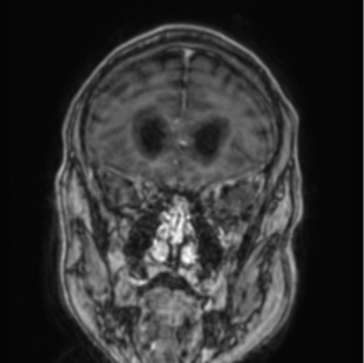 Cerebellar metastasis from lung adenocarcinoma (Radiopaedia 86690-102829 Coronal T1 C+ 72).png
