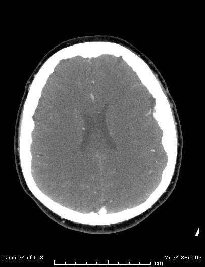 Cerebellar strokes due to intracranial giant cell arteritis (Radiopaedia 68799-78510 CT angiogram 34).jpg