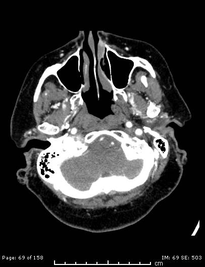 Cerebellar strokes due to intracranial giant cell arteritis (Radiopaedia 68799-78510 CT angiogram 69).jpg