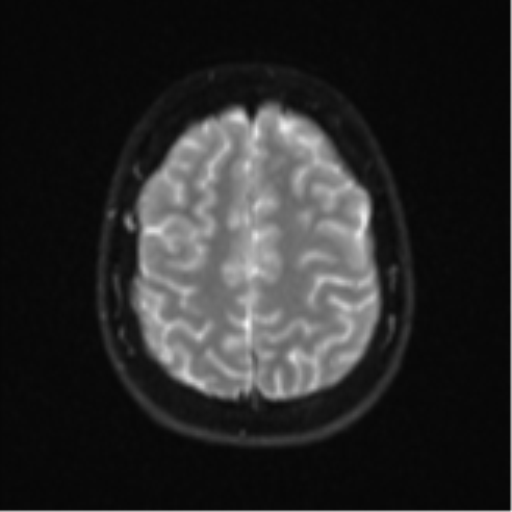 Cerebellar tuberculomas (Radiopaedia 46939-51472 Axial DWI 23).png