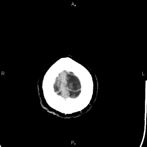 Cerebellopontine angle arachnoid cyst (Radiopaedia 85149-100704 Axial With contrast 52).jpg