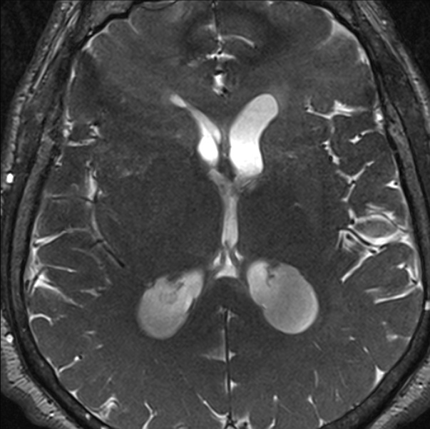 Cerebellopontine angle meningioma (Radiopaedia 24459-24764 I 60).jpg
