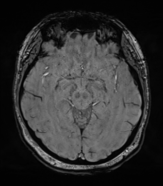 Cerebellopontine angle meningioma (Radiopaedia 48434-53348 Axial SWI 41).png