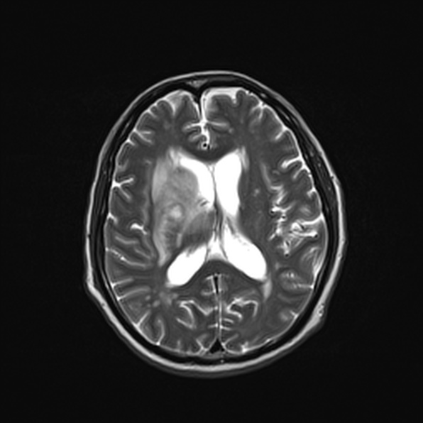 Cerebral abscess (Radiopaedia 26111-26247 Axial T2 37).jpg