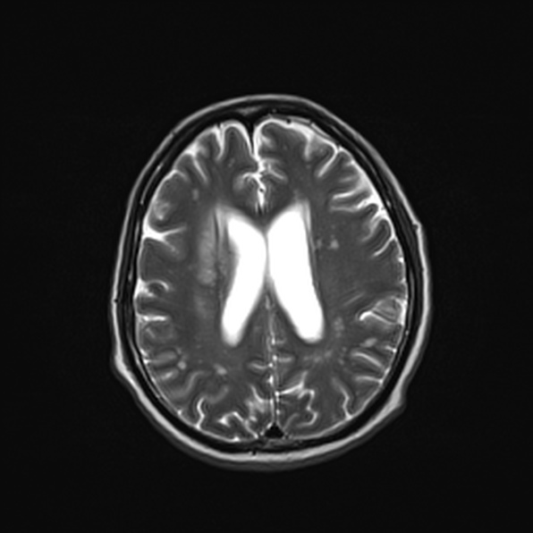 Cerebral abscess (Radiopaedia 26111-26247 Axial T2 40).jpg