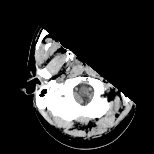 Cerebral abscess (Radiopaedia 29451-29919 Axial non-contrast 5).jpg