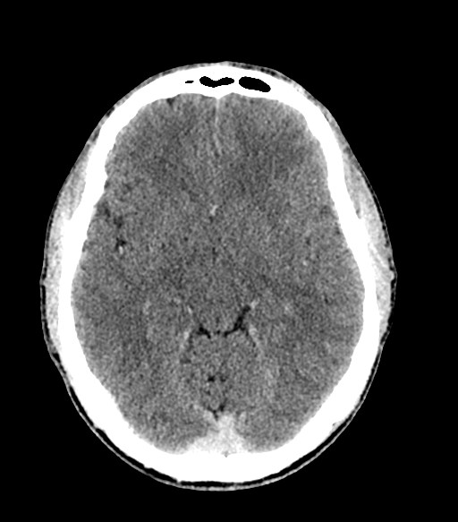 Cerebral abscess (Radiopaedia 57774-64741 Axial C+ delayed 32).png