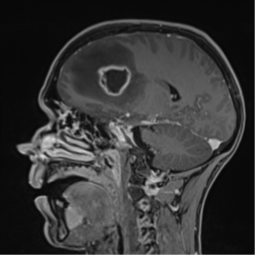 Cerebral abscess (Radiopaedia 60342-68009 J 34).png