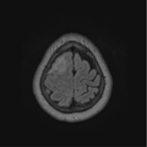 Cerebral abscess from pulmonary arteriovenous malformation (Radiopaedia 86275-102291 J 66).png