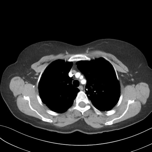 File:Cerebral abscess from pulmonary arteriovenous malformation (Radiopaedia 86275-102292 A 18).png