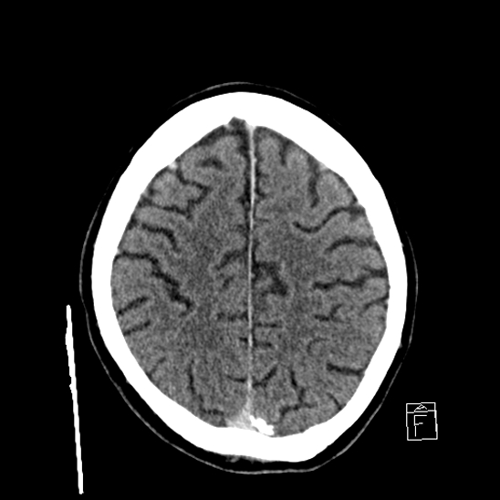 File:Cerebral abscess with ventriculitis (Radiopaedia 78965-91877 A 36).jpg